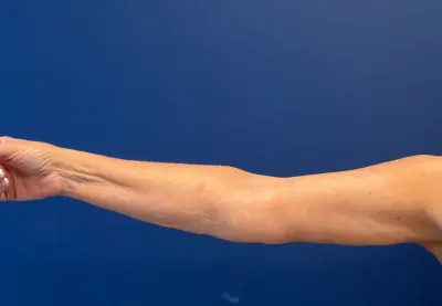 Arm Lift Case #4934 — after, Dr. Samir Rao