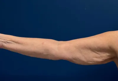 Arm Lift Case #4934 — before, Dr. Samir Rao
