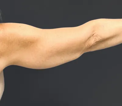 Arm Lift Case #6382 — after, Dr. Arjun Kanuri