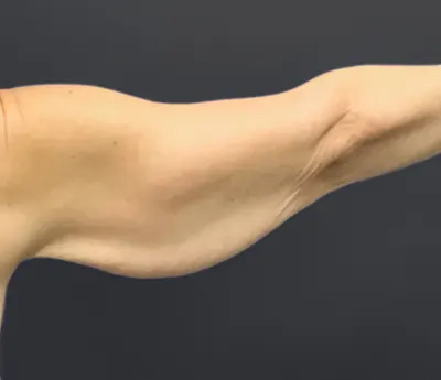 Arm Lift Case #6382 — before, Dr. Arjun Kanuri