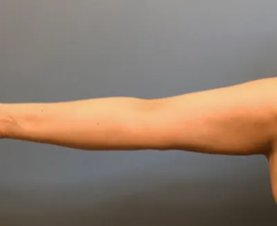 Arm Lift Case #78 — after, Dr. Samir Rao