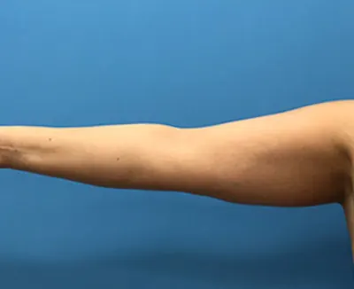 Arm Lift Case #78 — before, Dr. Samir Rao