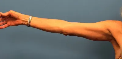 Arm Lift Case #8987 — after, Dr. Samir Rao