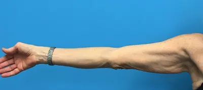 Arm Lift Case #8987 — before, Dr. Samir Rao