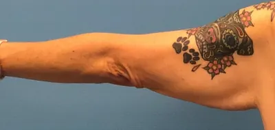 Arm Lift Case #brachioplasty — before, Dr. Samir Rao