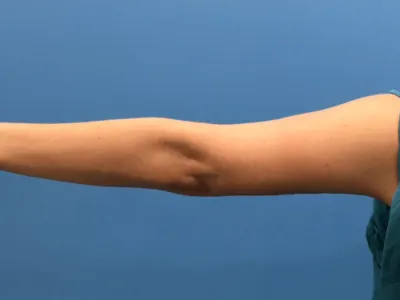 Arm Lift Case #276 — after, Dr. Samir Rao