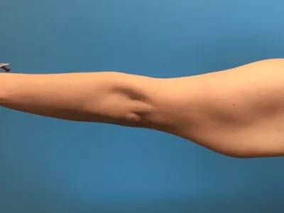 Arm Lift Case #276 — before, Dr. Samir Rao