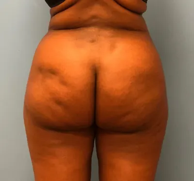 Brazilian Butt Lift (BBL) Case #13244 — after, Dr. Samir Rao