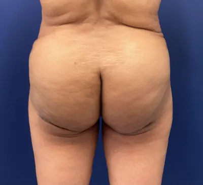 Brazilian Butt Lift (BBL) Case #215 — after, Dr. Samir Rao