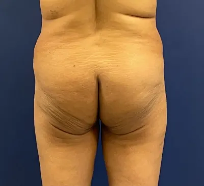 Brazilian Butt Lift (BBL) Case #215 — before, Dr. Samir Rao