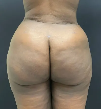 Brazilian Butt Lift (BBL) Case #353 — after, Dr. Arjun Kanuri