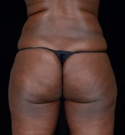 Brazilian Butt Lift (BBL) Case #353 — before, Dr. Arjun Kanuri