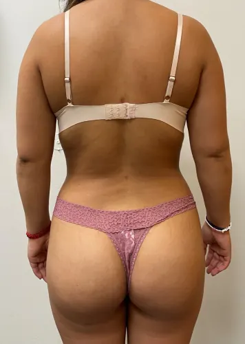 Brazilian Butt Lift (BBL) Case #367 — after, Dr. Arjun Kanuri