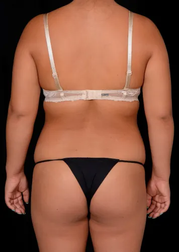 Brazilian Butt Lift (BBL) Case #367 — before, Dr. Arjun Kanuri