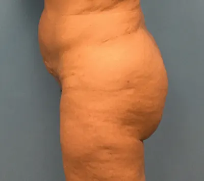 Brazilian Butt Lift (BBL) Case #74 — after, Dr. Samir Rao