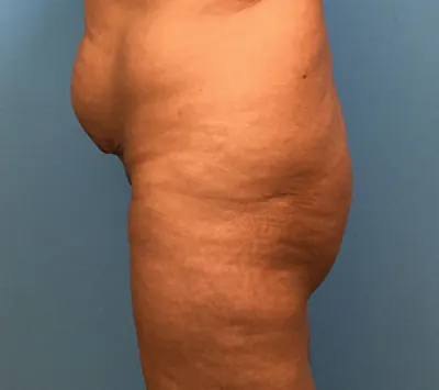 Brazilian Butt Lift (BBL) Case #74 — before, Dr. Samir Rao