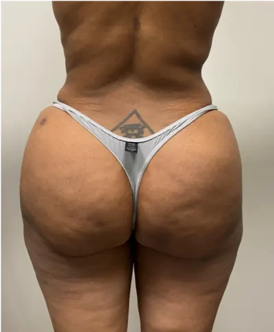 Brazilian Butt Lift (BBL) Case #7979 — after, Dr. Arjun Kanuri
