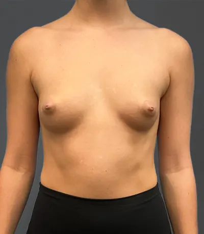 Breast Augmentation Case #2384 — before, Dr. Arjun Kanuri