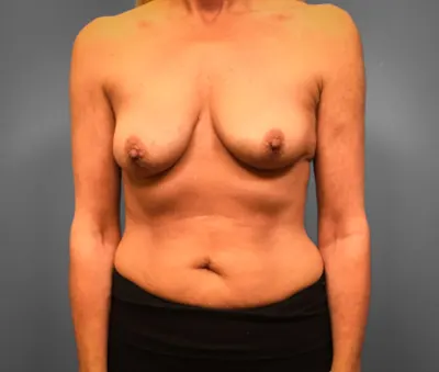 Breast Augmentation Case #breast-augmentation-before-after — before, Dr. Samir Rao