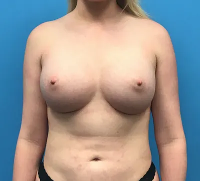 Breast Augmentation Case #219 — after, Dr. Samir Rao