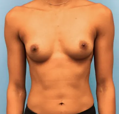Breast Augmentation Case #221 — before, Dr. Samir Rao