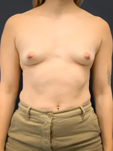 Breast Augmentation Case #2225 — before, Dr. Arjun Kanuri