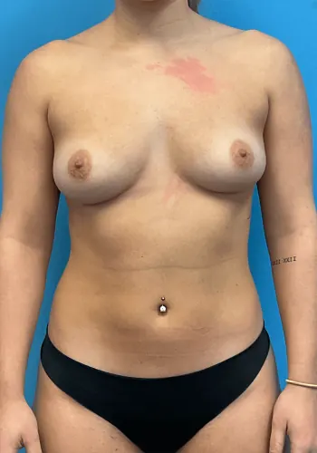 Breast Augmentation Case #23895 — before, Dr. Frank Albino