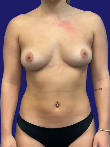 Breast Augmentation Case #23895 — before, Dr. Frank Albino