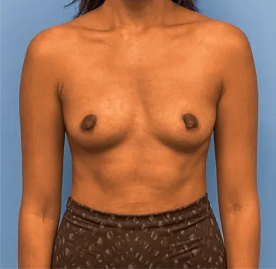 Breast Augmentation Case #25592 — before, Dr. Samir Rao