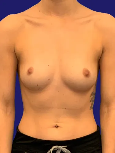 Breast Augmentation Case #2686897 — before, Dr. Frank Albino