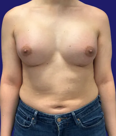 Breast Augmentation Case #2719 — after, Dr. Frank Albino