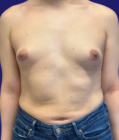 Breast Augmentation Case #2719 — before, Dr. Frank Albino