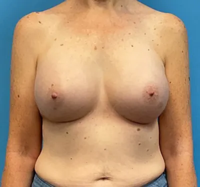 Breast Augmentation Case #27374 — after, Dr. Frank Albino