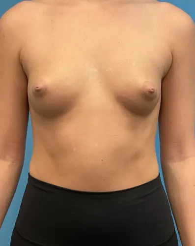 Breast Augmentation Case #3397 — before, Dr. Arjun Kanuri