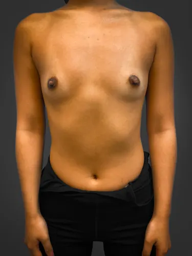 Breast Augmentation Case #4631 — before, Dr. Frank Albino