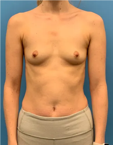 Breast Augmentation Case #5309 — before, Dr. Arjun Kanuri