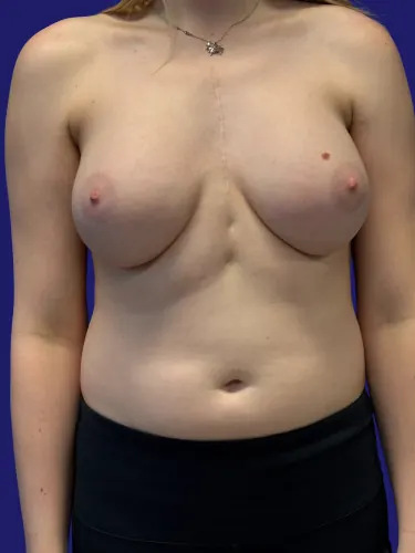Breast Augmentation Case #5465752 — after, Dr. Frank Albino