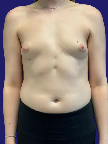 Breast Augmentation Case #5465752 — before, Dr. Frank Albino