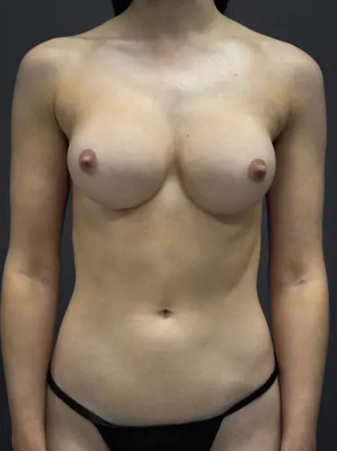 Breast Augmentation Case #6687 — after, Dr. Arjun Kanuri