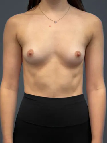 Breast Augmentation Case #6687 — before, Dr. Arjun Kanuri