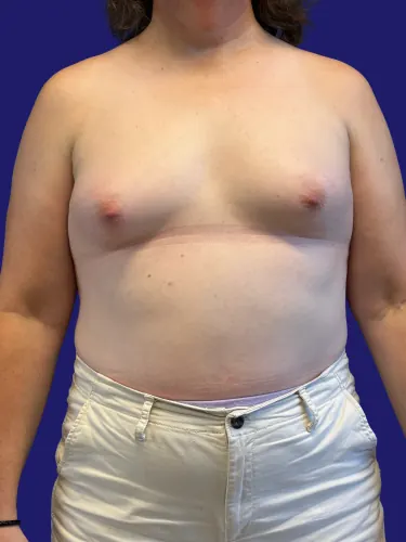 Breast Augmentation Case #7022385 — before, Dr. Frank Albino
