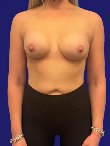 Breast Augmentation Case #747892 — after, Dr. Frank Albino