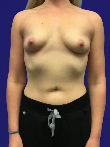 Breast Augmentation Case #747892 — before, Dr. Frank Albino