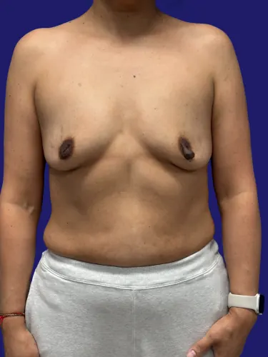 Breast Augmentation Case #7583361 — before, Dr. Frank Albino