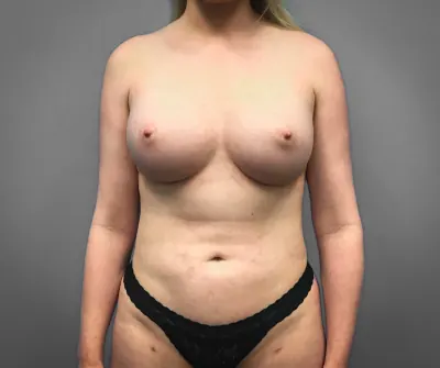 Breast Augmentation Case #9094 — after, Dr. Samir Rao