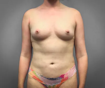 Breast Augmentation Case #9094 — before, Dr. Samir Rao