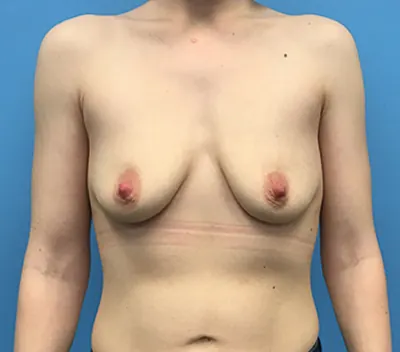 Breast Augmentation Case #93 — before, Dr. Frank Albino
