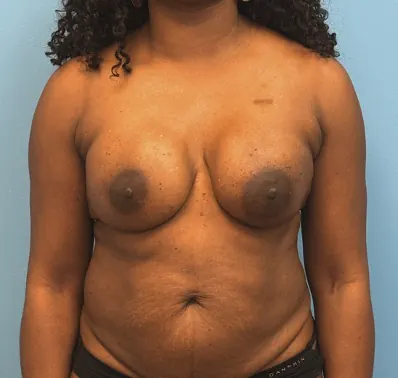 Breast Reconstruction Case #23930 — after, Dr. Samir Rao
