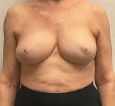 Breast Reconstruction Case #24804 — after, Dr. Frank Albino