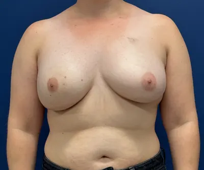 Breast Reconstruction Case #28689 — after, Dr. Samir Rao